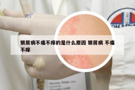 银屑病不痛不痒的是什么原因 银屑病 不痛不痒