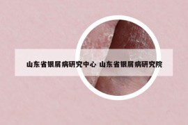 山东省银屑病研究中心 山东省银屑病研究院