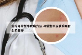 治疗寻常型牛皮癣方法 寻常型牛皮肤癣用什么药最好