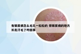 有银屑病怎么毛孔一粒粒的 得银屑病的地方长出汗毛了咋回事