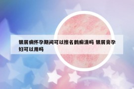 银屑病怀孕期间可以擦名鹤癣清吗 银屑膏孕妇可以用吗