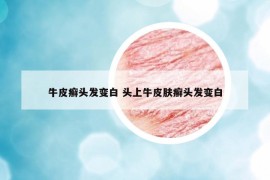 牛皮癣头发变白 头上牛皮肤癣头发变白