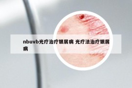 nbuvb光疗治疗银屑病 光疗法治疗银屑病