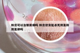 林旦可以治银屑病吗 林旦软膏能杀死阴虱和阴虱卵吗