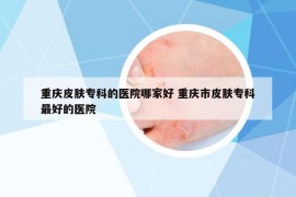 重庆皮肤专科的医院哪家好 重庆市皮肤专科最好的医院