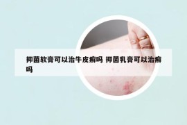 抑菌软膏可以治牛皮癣吗 抑菌乳膏可以治癣吗