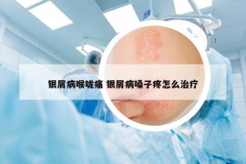 银屑病喉咙痛 银屑病嗓子疼怎么治疗