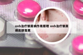 uvb治疗银屑病作用原理 uvb治疗银屑病皮肤变黑