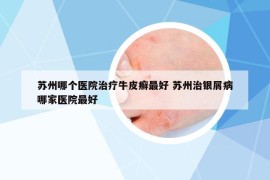 苏州哪个医院治疗牛皮癣最好 苏州治银屑病哪家医院最好