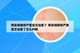 银屑病瘙痒严重是否加重了 银屑病瘙痒严重是否加重了怎么判断