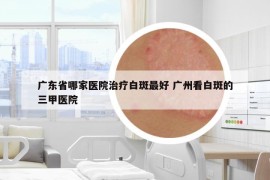 广东省哪家医院治疗白斑最好 广州看白斑的三甲医院