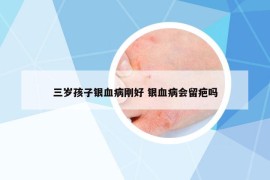 三岁孩子银血病刚好 银血病会留疤吗