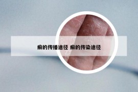 癣的传播途径 癣的传染途径