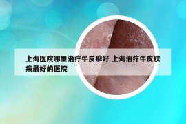 上海医院哪里治疗牛皮癣好 上海治疗牛皮肤癣最好的医院