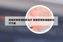 脓疱型银屑病最新治疗 脓疱型银屑病最新治疗方案