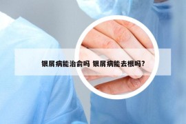 银屑病能治俞吗 银屑病能去根吗?