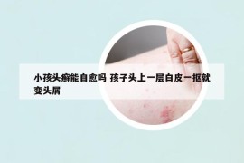 小孩头癣能自愈吗 孩子头上一层白皮一抠就变头屑