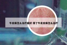 牛皮癣怎么治疗最好 得了牛皮皮癣怎么治疗