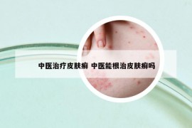 中医治疗皮肤癣 中医能根治皮肤癣吗