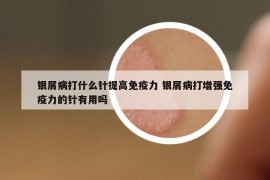 银屑病打什么针提高免疫力 银屑病打增强免疫力的针有用吗