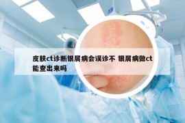 皮肤ct诊断银屑病会误诊不 银屑病做ct能查出来吗