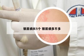 银屑病长5个 银屑病多不多