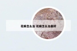 花癣怎么治 花癣怎么治最好