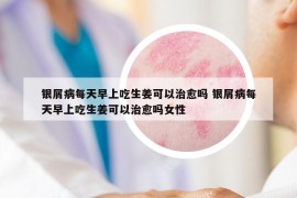 银屑病每天早上吃生姜可以治愈吗 银屑病每天早上吃生姜可以治愈吗女性