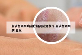 点滴型银屑病治疗期间反复发作 点滴型银屑病 复发