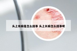 头上有癣是怎么回事 头上长癣怎么回事呢