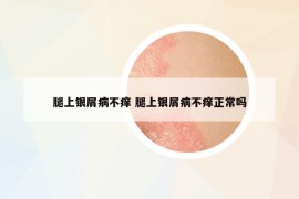 腿上银屑病不痒 腿上银屑病不痒正常吗