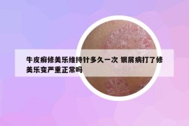 牛皮癣修美乐维持针多久一次 银屑病打了修美乐变严重正常吗