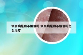 银屑病是血小板低吗 银屑病是血小板低吗怎么治疗