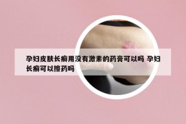 孕妇皮肤长癣用没有激素的药膏可以吗 孕妇长癣可以擦药吗