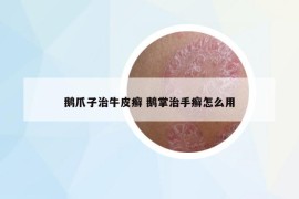 鹅爪子治牛皮癣 鹅掌治手癣怎么用