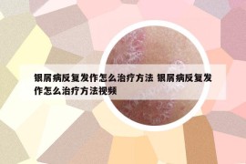 银屑病反复发作怎么治疗方法 银屑病反复发作怎么治疗方法视频