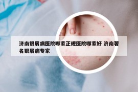 济南银屑病医院哪家正规医院哪家好 济南著名银屑病专家