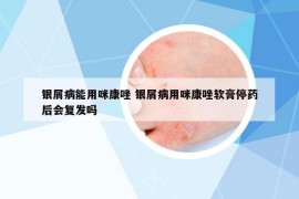 银屑病能用咪康唑 银屑病用咪康唑软膏停药后会复发吗