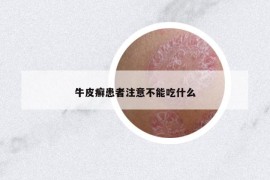 牛皮癣患者注意不能吃什么