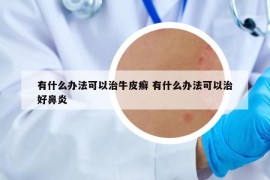 有什么办法可以治牛皮癣 有什么办法可以治好鼻炎