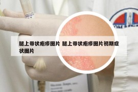 腿上带状疱疹图片 腿上带状疱疹图片初期症状图片