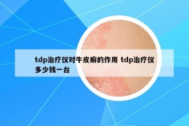 tdp治疗仪对牛皮癣的作用 tdp治疗仪多少钱一台