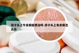 孩子头上牛皮癣能根治吗 孩子头上有皮癣怎么办