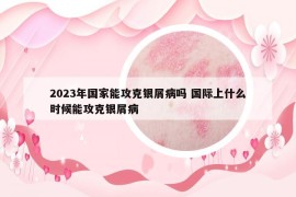 2023年国家能攻克银屑病吗 国际上什么时候能攻克银屑病