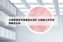 小孩身体长牛皮癣怎么治疗 小孩身上长牛皮肤癣怎么办