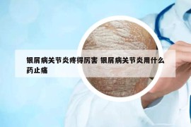 银屑病关节炎疼得厉害 银屑病关节炎用什么药止痛