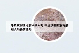 牛皮肤癣血液传染别人吗 牛皮肤癣血液传染别人吗会传染吗