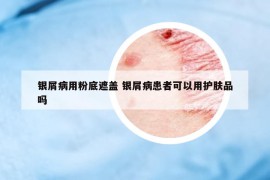 银屑病用粉底遮盖 银屑病患者可以用护肤品吗