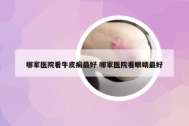 哪家医院看牛皮癣最好 哪家医院看眼睛最好