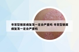 寻常型银屑病复发一定会严重吗 寻常型银屑病复发一定会严重吗